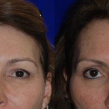 botox before and after Juvederm Botox filler